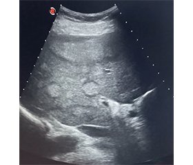 Гепатоцелюлярна карцинома: сучасні аспекти міждисциплінарного менеджменту. Частина 1. Епідеміологія, фактори ризику, діагностика