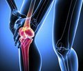 The role of combined chondroprotectors in the comprehensive treatment of osteoarthritis