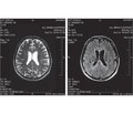 Damage to the nervous system associated with HIV infection (a clinical case)