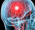 Дзеркальна терапія у фізичній нейрореабілітації пацієнтів після мозкового інсульту