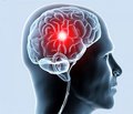 Лечение и профилактика когнитивных нарушений  у пациентов с хроническим нарушением мозгового кровообращения