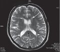 Магнитно-резонансная томография пpи хронической ишемии мозга гипертонического и атеросклеротического генеза