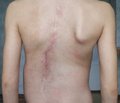 A Comparison of Two Types of Postoperative Pain Control After Scoliosis Surgery